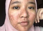 Buka Mata! Arti Mimpi Muka Berjerawat Parah : Pertanda Baik atau Buruk? Kuak Misterinya!