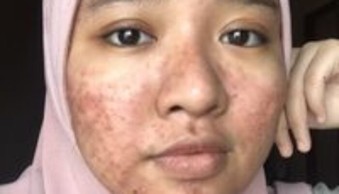 Buka Mata! Arti Mimpi Muka Berjerawat Parah : Pertanda Baik atau Buruk? Kuak Misterinya!