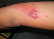 Penafsiran Unik: Arti Mimpi Luka Di Kaki Temukan Makna Rahasianya Disini