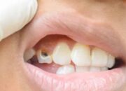 Kenali Arti Mimpi Gigi Keropos : Ini Penjelasannya