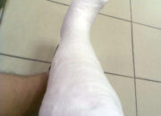 Penafsiran Unik: Arti Mimpi Kaki Patah Temukan Makna Rahasianya Disini