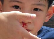 Kenali Arti Mimpi Hidung Berdarah Ternyata Ini Artinya Menurut Pakar