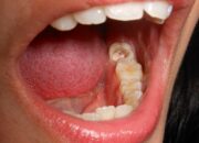 Kisah di Balik Arti Mimpi Gigi Berlubang Ternyata Ini Artinya Menurut Pakar