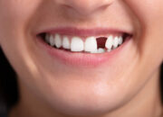 Misteri Terungkap: Arti Mimpi Gigi Copot Bagian Atas Depan : Ini Penjelasannya