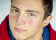 Buka Mata! Arti Mimpi Muka Berjerawat : Ini Penjelasannya