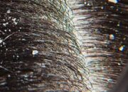 Misteri Terungkap: Arti Mimpi Banyak Ketombe : Ini Penjelasannya