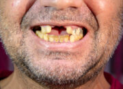 Arti Mimpi Gigi Mau Copot : Ini Penjelasannya