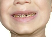 Kenali Arti Mimpi Gigi Rusak : Ini Penjelasannya