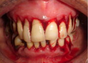 Wah, Arti Mimpi Gusi Berdarah  yang Perlu Diketahui