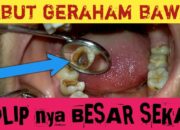 Buka Mata! Arti Mimpi Cabut Gigi Geraham Bawah Ke Dokter : Ini Penjelasannya
