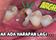 Buka Mata! Arti Mimpi Gigi Belakang Bawah Copot Ternyata Ini Artinya Menurut Pakar