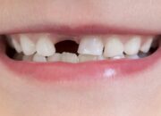 Misteri Terungkap: Arti Mimpi Gigi Atas Patah Setengah  yang Perlu Diketahui