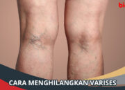 5 Tips Mencegah Timbulnya Varises dengan Mudah