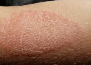 10 Macam Penyakit Kulit Umum dan Cara Mengobatinya