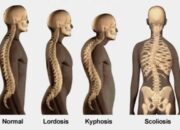 10 Jenis Penyakit Tulang dan Penyebabnya yang Harus Kamu Tahu